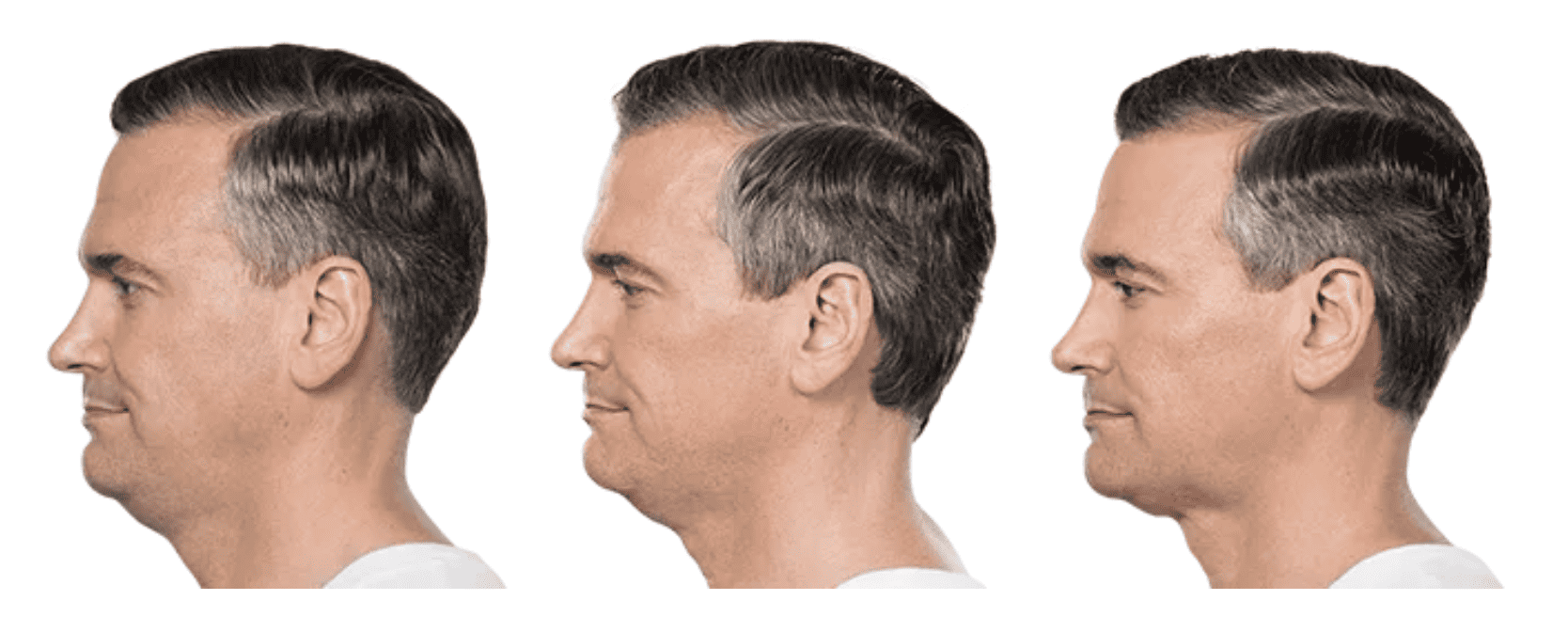 Before and after photos of Kybella treatments.
