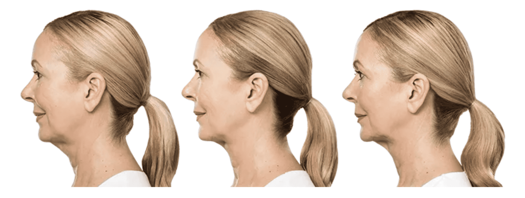 Before and after photos of Kybella treatments.