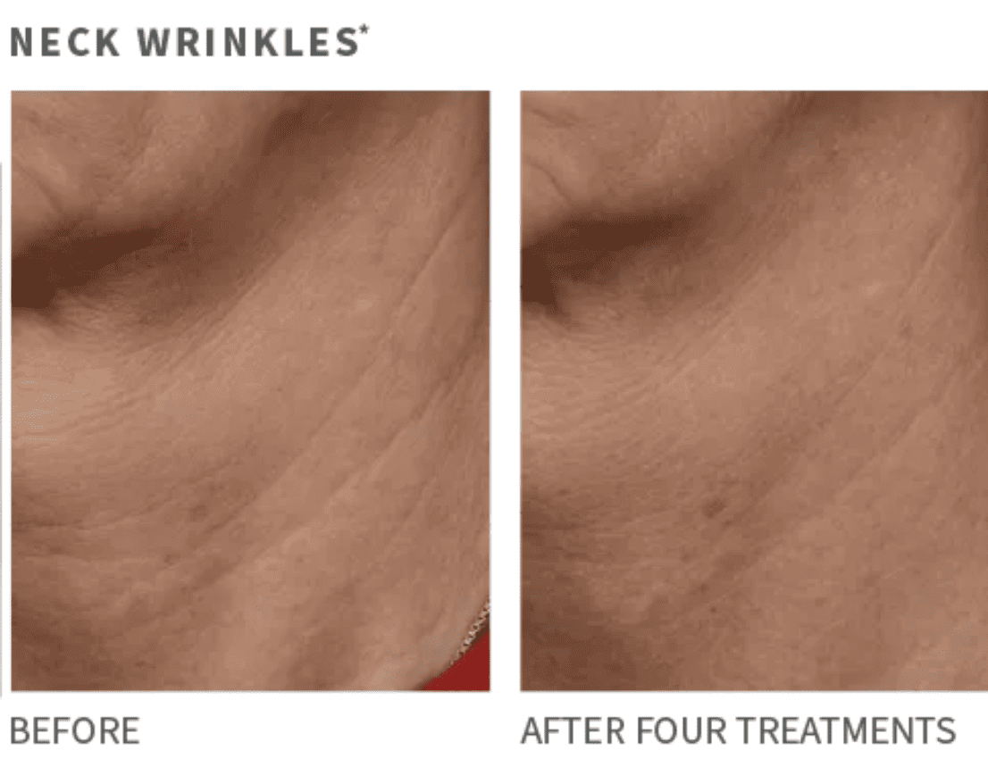 Microneedling before and after.