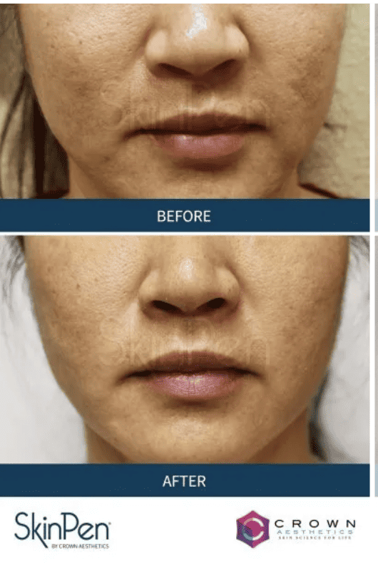 Microneedling before and after.