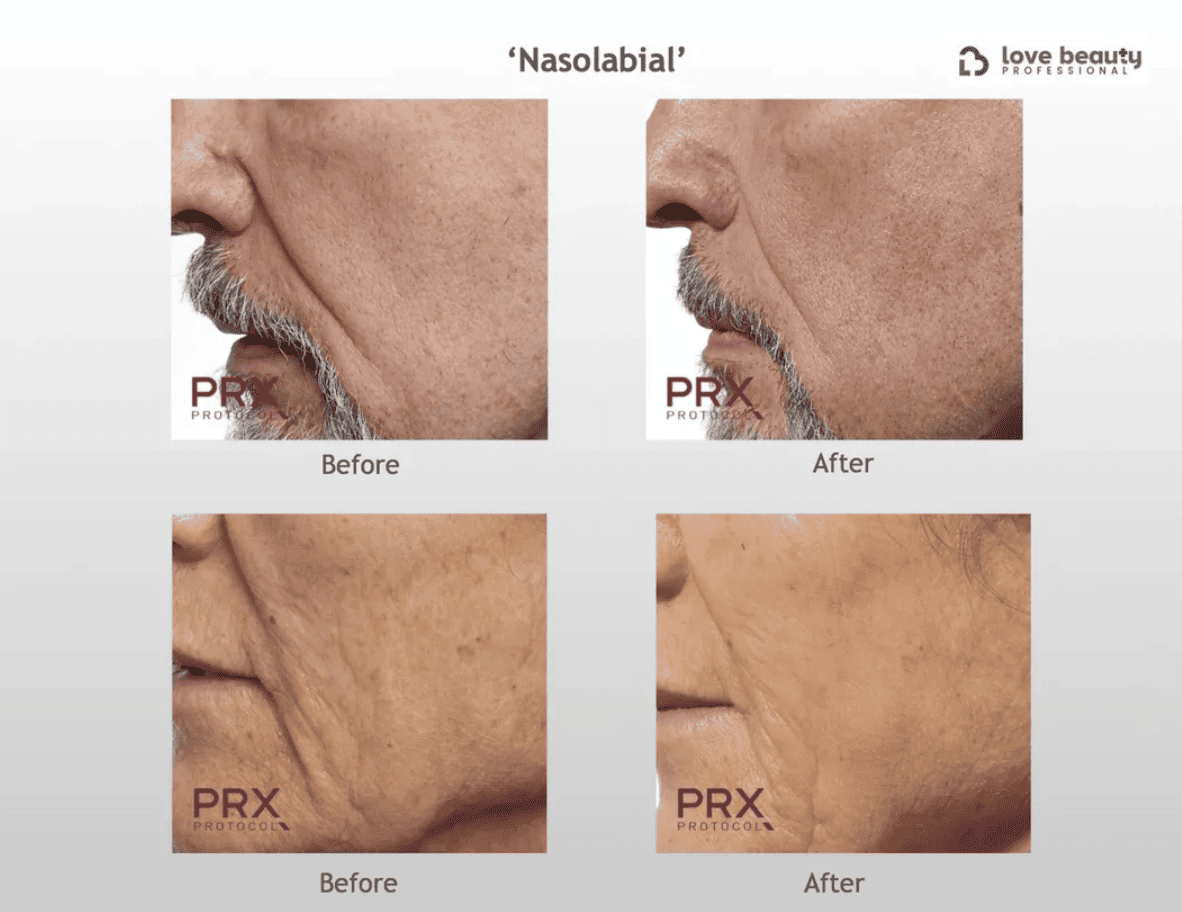 PRX-T33 before and after