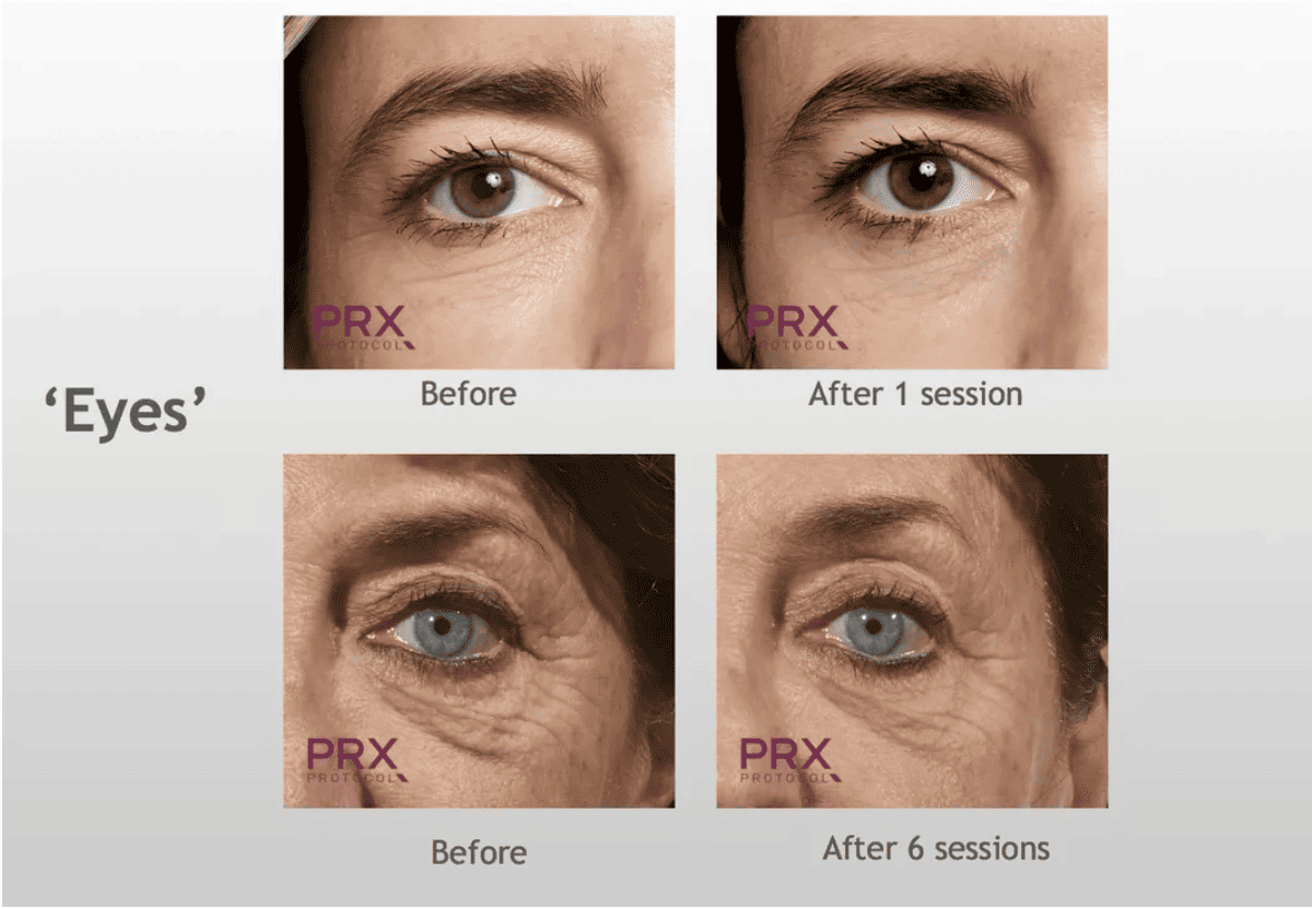 PRX-T33 before and after