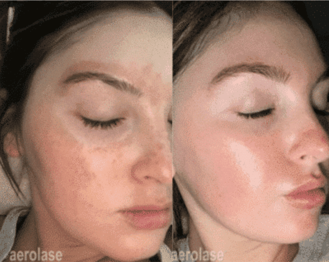Before and after treatment using an Aerolase Neo Elite Laser.