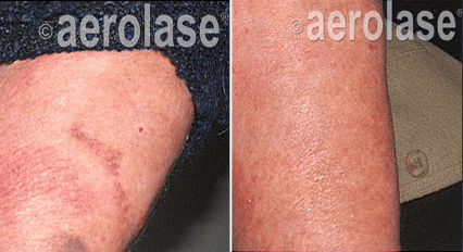 Defining Beauty Wellness & Med Spa in Tampa offers Aerolase Neo Elite Laser.