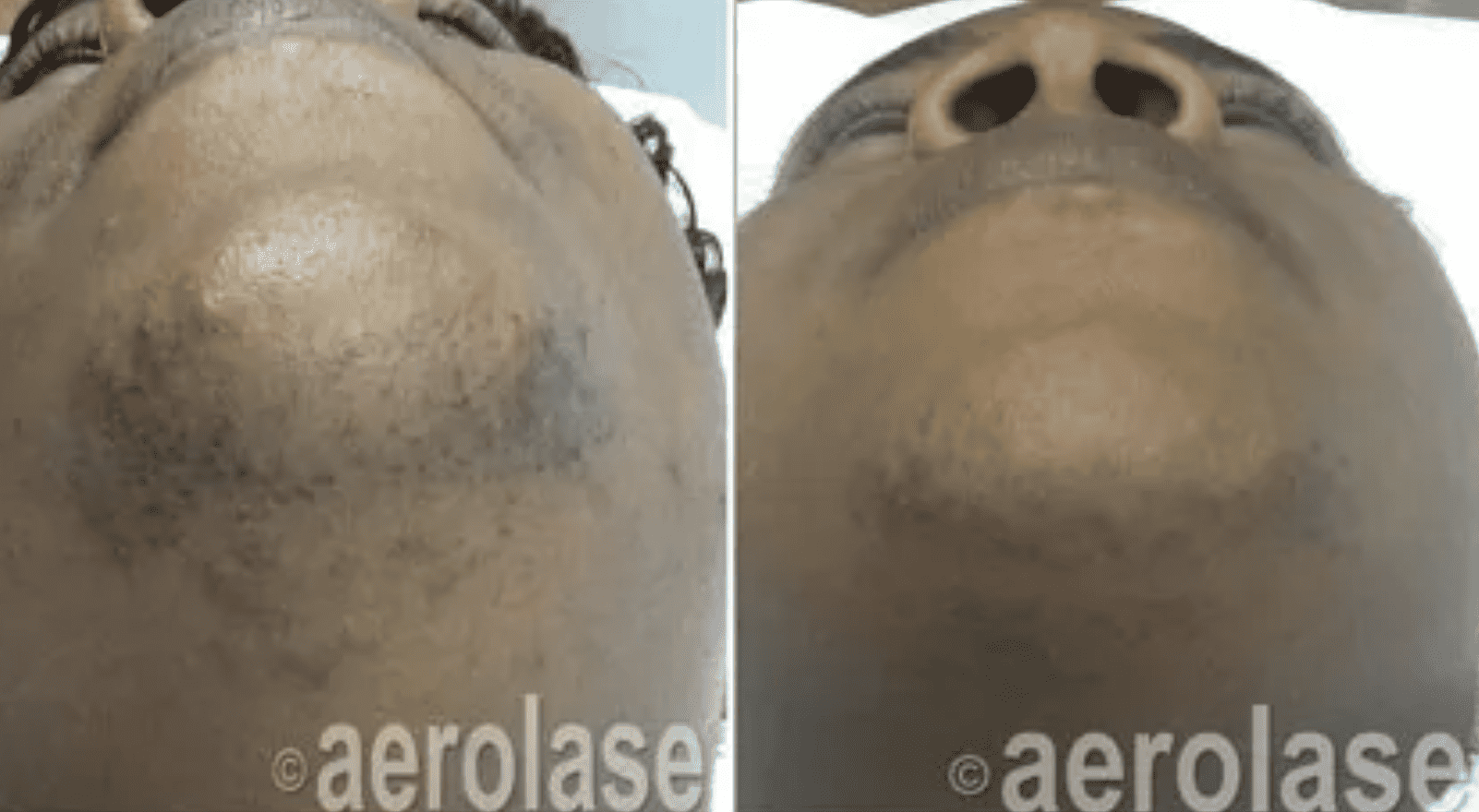 Before and after treatment using an Aerolase Neo Elite Laser.