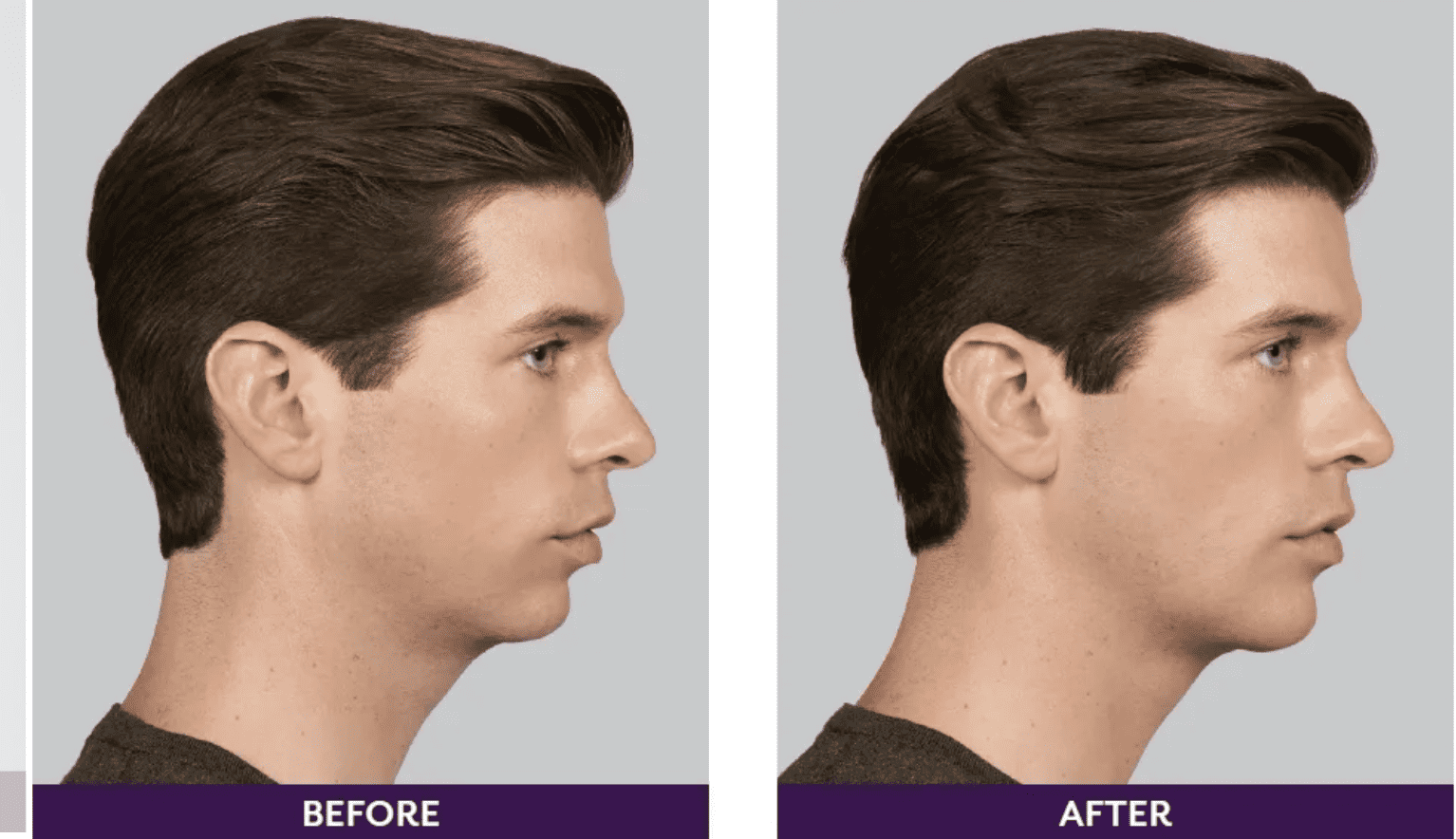 Before and after image of dermal filler.