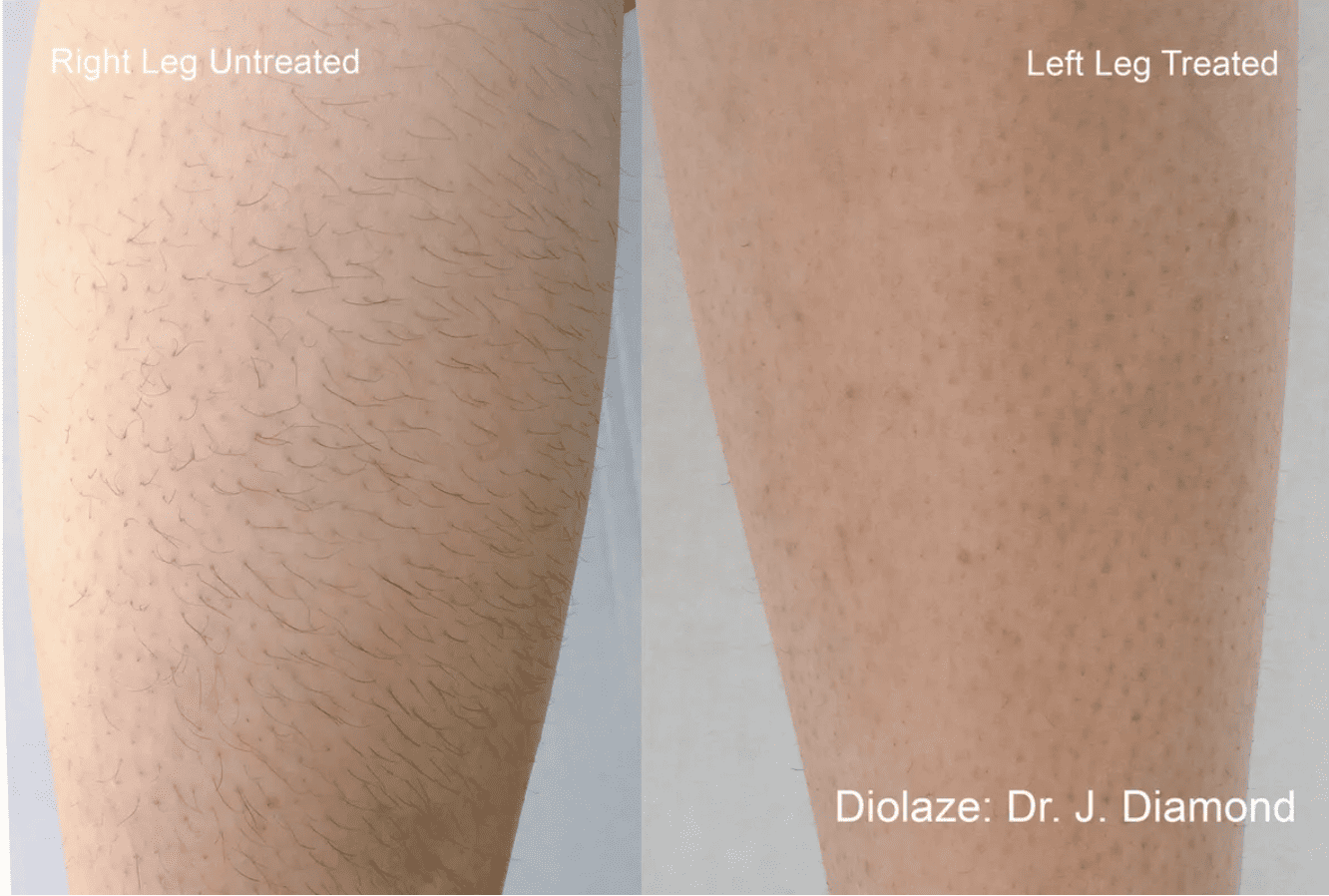 Before and after shots of laser hair removal on the leg.
